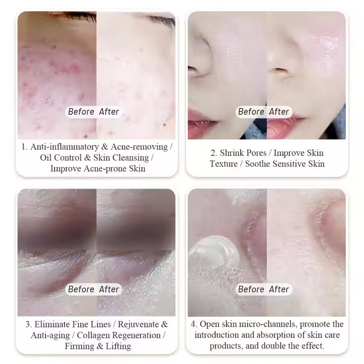 2023 Leaflife New Innovative Technology Face Lifting Skin Rejuvenation Profasma Jet Plasma Pen for Face and Neck